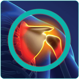 Validating a Computational Model of Reverse Shoulder Arthroplasty