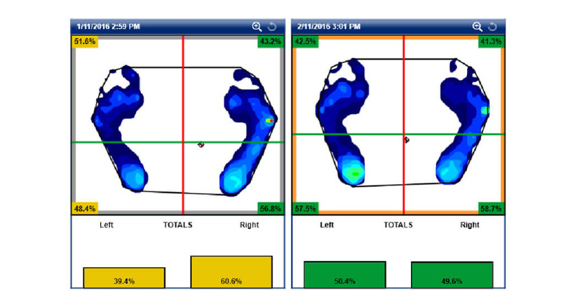 Weight distribution before and after treatment using SportsAT
