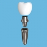 t-scan for dental implant prosthesis