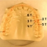 occlusal load and articulating paper