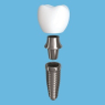 T-Scan Dental Implant
