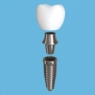 t-scan for dental implant prosthesis