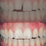 Cosmetic Veneers