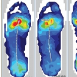 Validating Orthotic Interventions with F-Scan