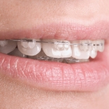 Dental Occlusion of Post-Orthodontic and Non-Orthodontic Subjects Studied