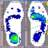 Identifying Signs of Limb Length Differences with F-Scan