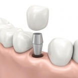 Preventing Implant Complications Using Case-Finishing Technology