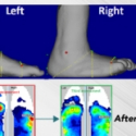 offloading a charcot foot deformity with f-scan system