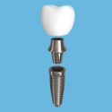 T-Scan Dental Implant