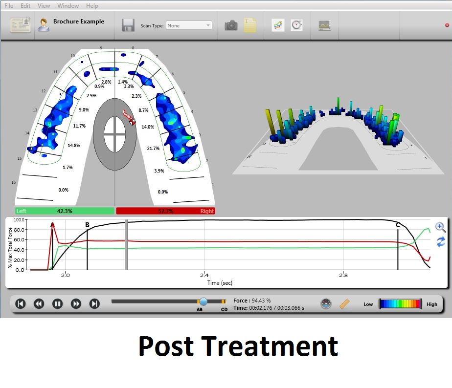 T-Scan denture patient: Post-adjustment, bite is more balanced across dentition