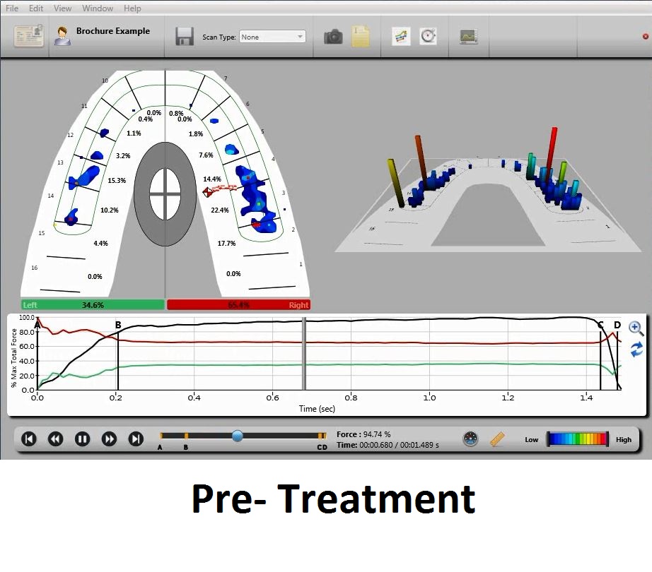 T-Scan denture patient: Premature contacts causing denture to rock