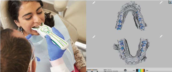 T-Scan Vs intraoral scanners