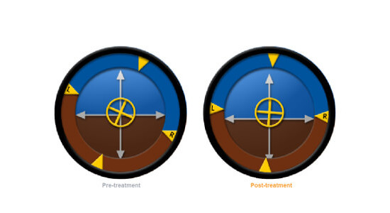 Using SportsAT for Balance Assessments & Rehabilitation