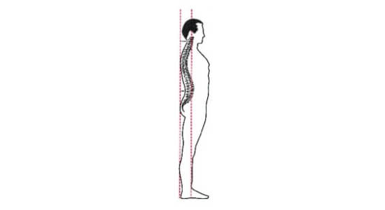 Using Sway Analysis to Treat Postural Misalignments